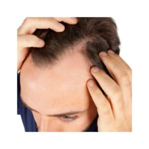 Hair Loss