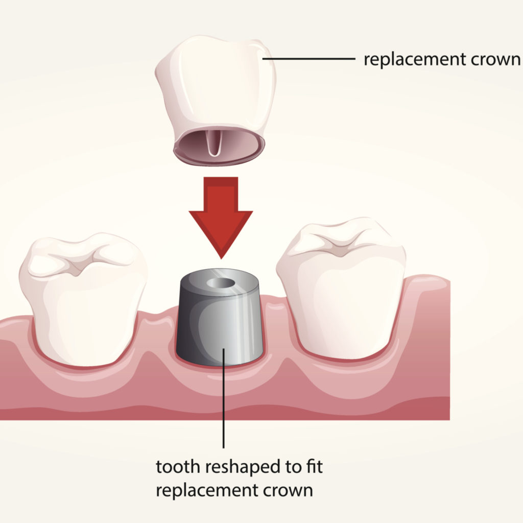 dental crown for tooth